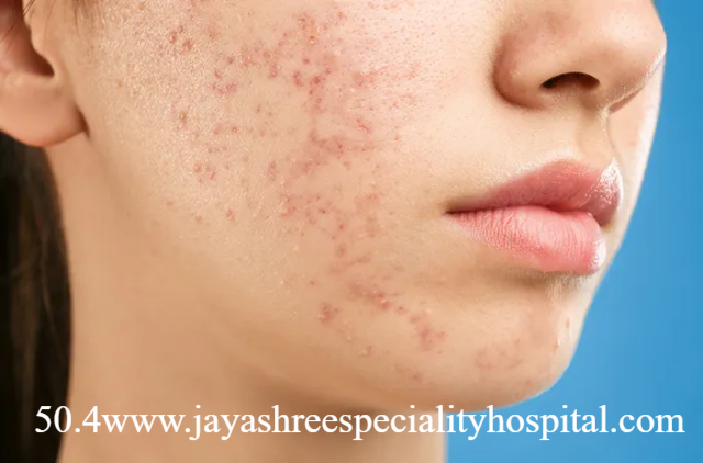 Berbagai Munculnya Jerawat di Pipi